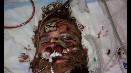 Kelly Thomas, after being brutally beaten by officers Jay Cicinelli and Manuel Ramos, of the Fullerton, California police department